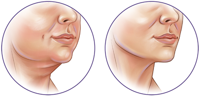 Liposuction under chin